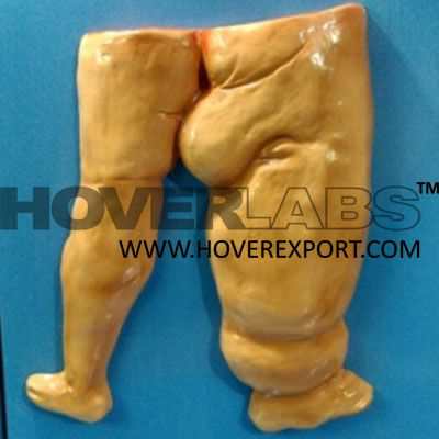 Elephantiasis Model