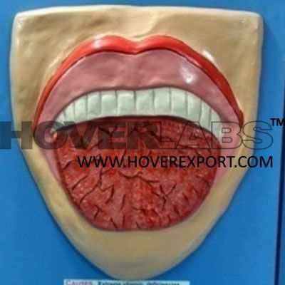 Angular Stomatitis Glossitis Model