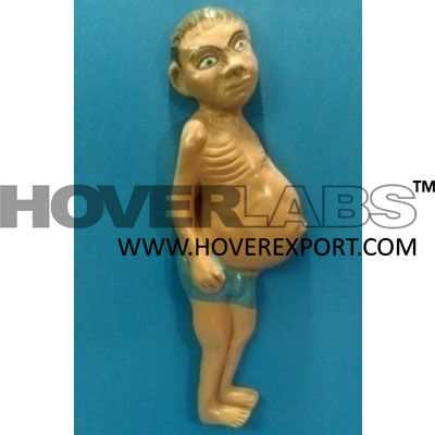 Kwashiorkor Model